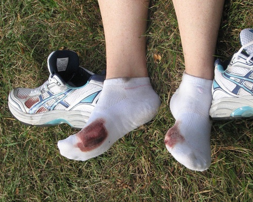 Estado dos pés ao final de uma maratona. (soundfromwayout/flickr)
