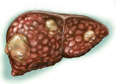 Fígado e Hepatite B